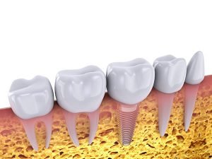 9 Things You Should Know About Dental Implants dentist arana hills