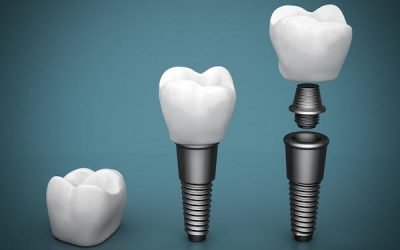 Dental Implants in Arana Hills: Should You Shop Around?