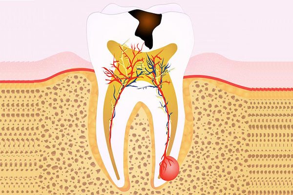 The Ultimate Guide to Root Canal Treatment in Arana Hills