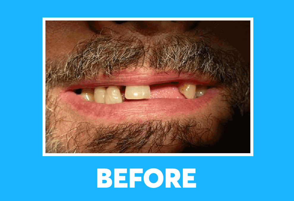 Before and after image of man getting dentistry treatment at DentArana