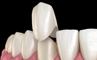 The Pros and Cons of Dental Crowns