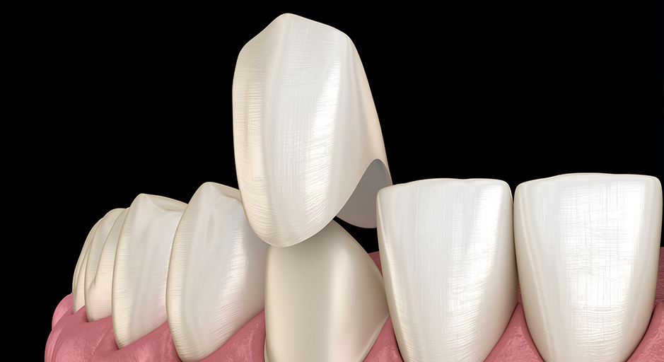 The Pros and Cons of Dental Crowns