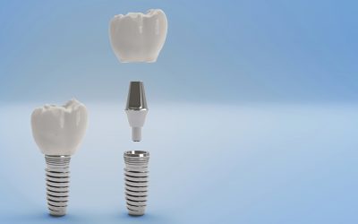 Thinking of Dental Implants? Here’s What You Need to Know