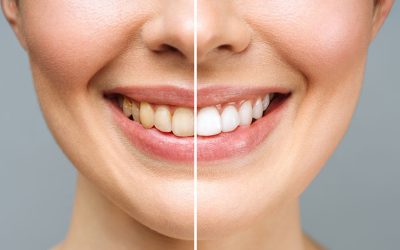 Professional vs. DIY Teeth Whitening: Which Method Shines Brightest?